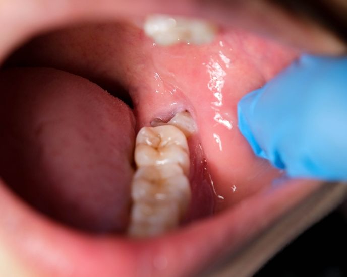 Extracción dental y muelas del juicio