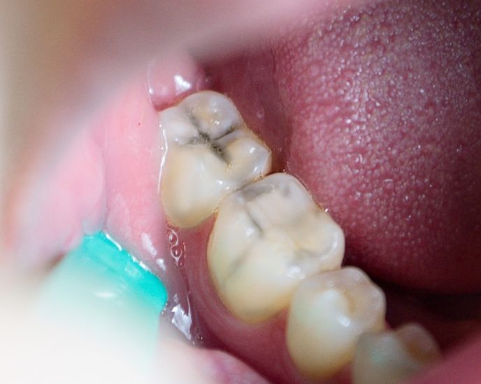 Alivio del dolor dental y muelas picadas