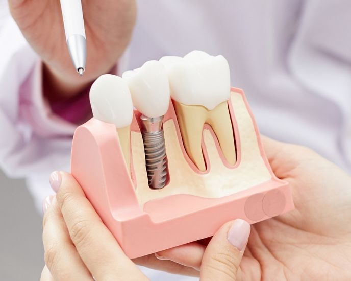 Prótesis e implantes dentales